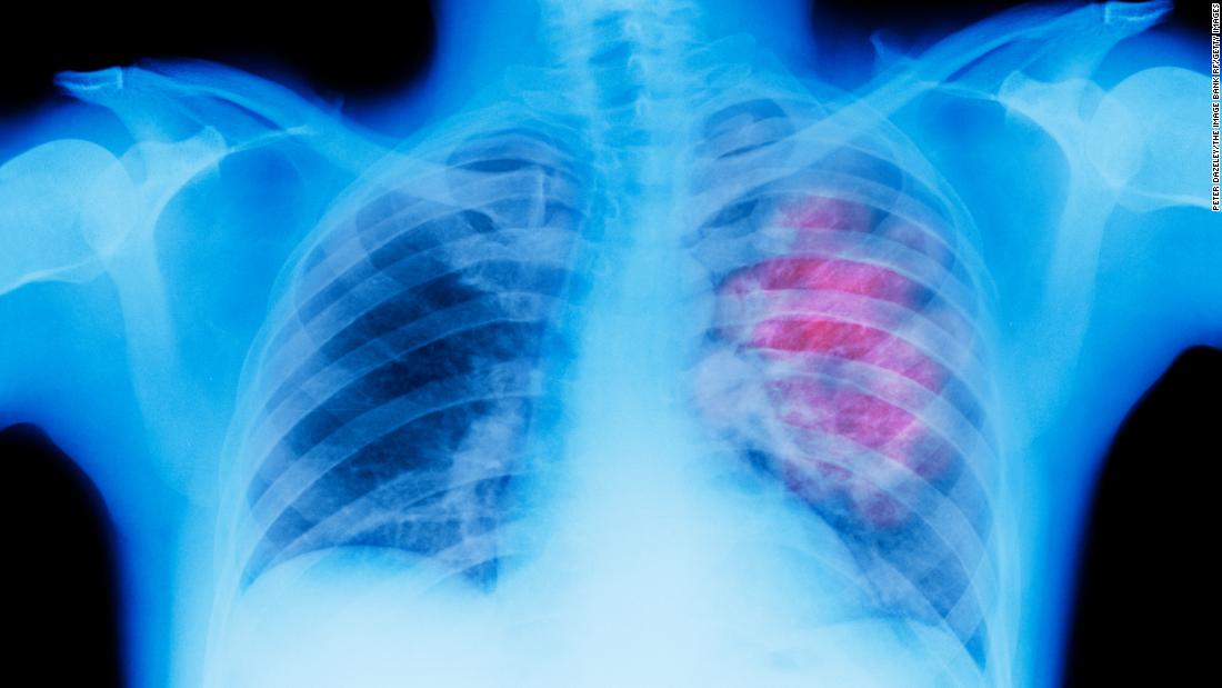 US lung cancer survival rate rises 21%, report says, but much work remains